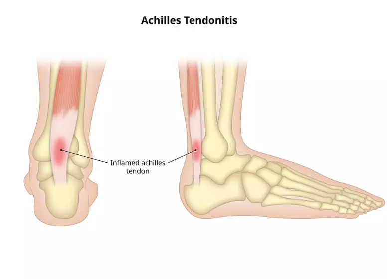 Treatment for Achilles Tendonitis